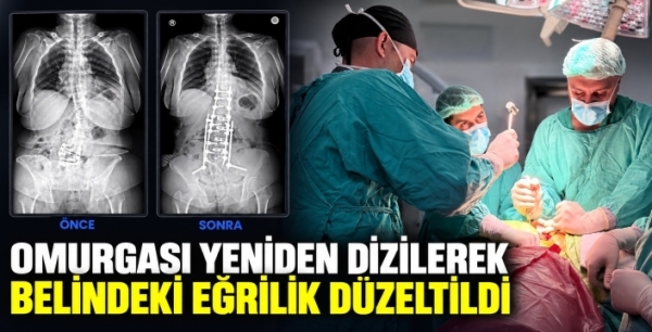 Omurgası yeniden dizilerek belindeki eğrilik düzeltildi